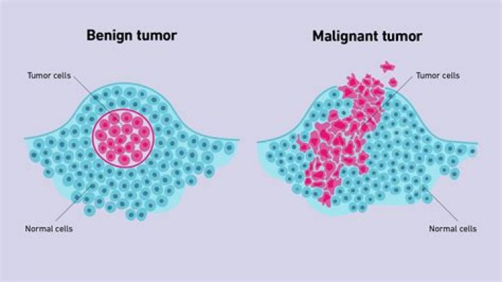 Malignant