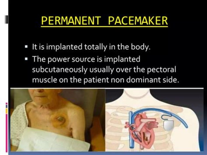 Patient Successfully Implanted with Permanent Heart Implant, the Only FDA-Approved Device to Reduce Stroke Risk