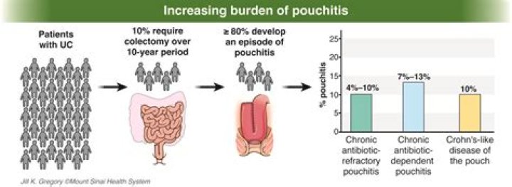 Pouchitis: What It Is and How to Cope with It