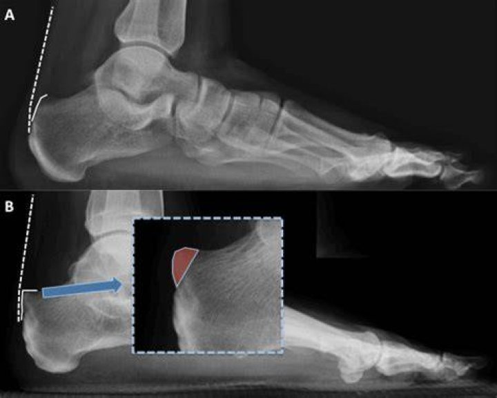 What is the icd 10 code for haglunds deformity