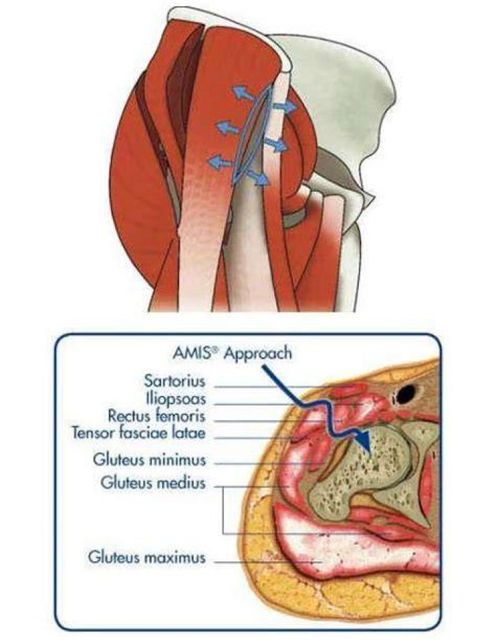 When Would the Direct Anterior Approach for THA Be Contraindicated?